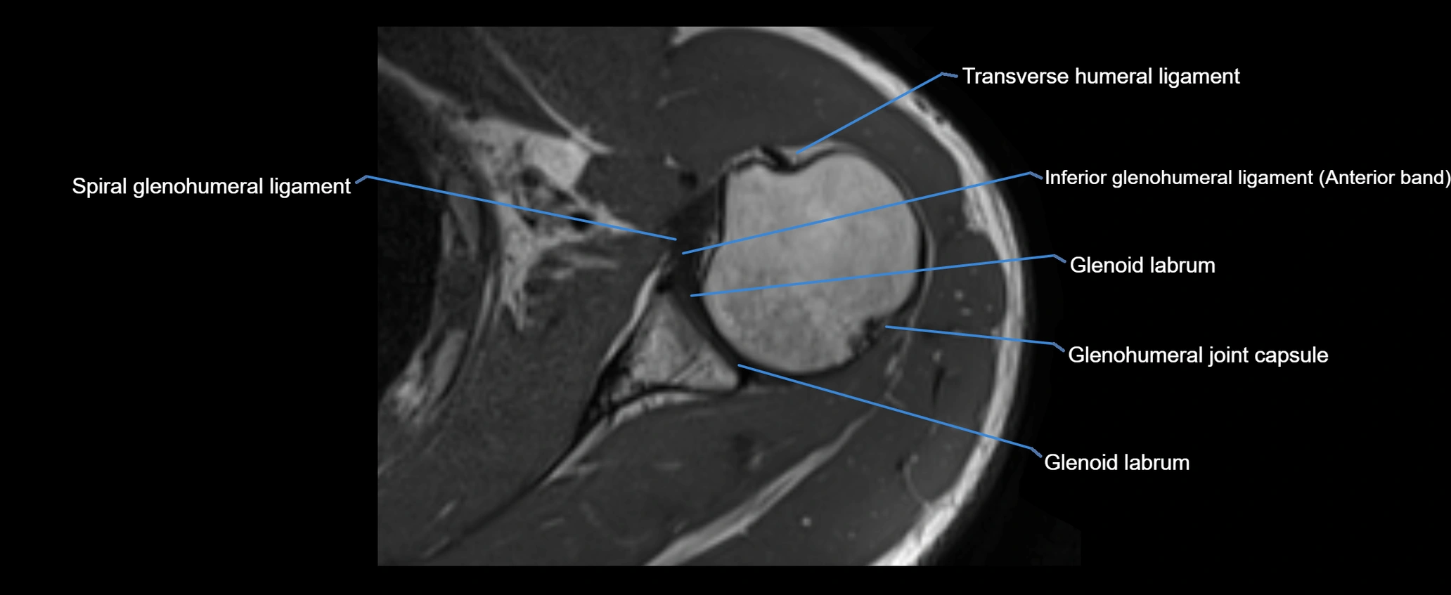 shoulder ligaments axial 3d 3t mri image-img-00005-00073.webp